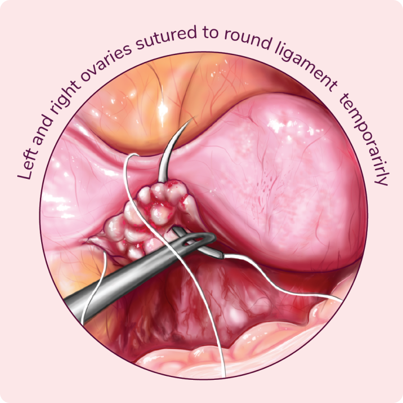 Ovaries Suture