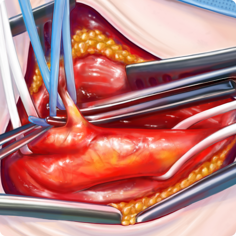 Surgery